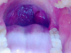 Tongue, Tonsils, and Throat Examination