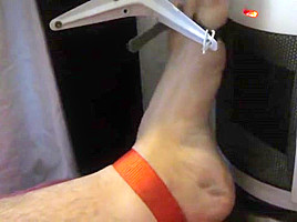 Tortured foot roasted by heating after bastinado and falaka