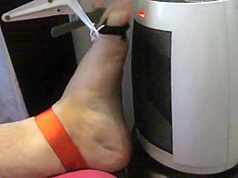Tortured foot roasted by heating after bastinado and falaka