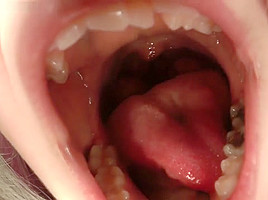 cag lilly's uvula